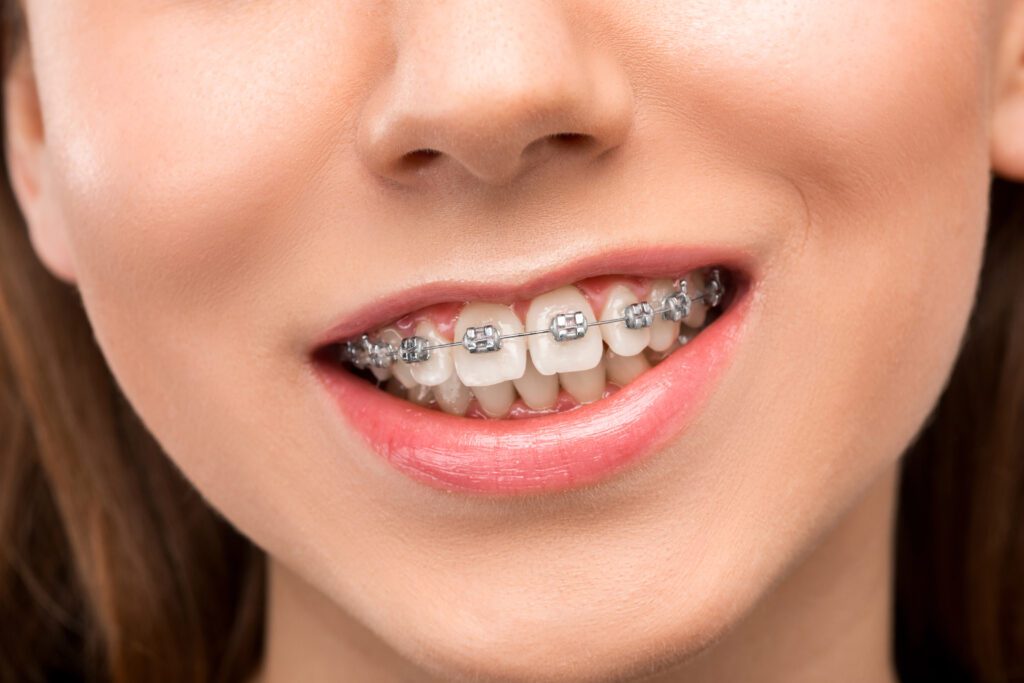 Braces medical tourism-5 Best countries