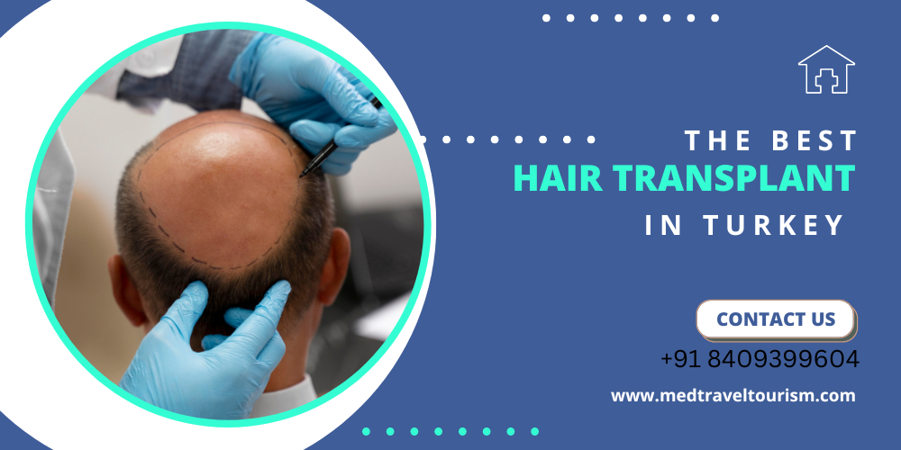 Best hair transplant in turkey-2023 reviews