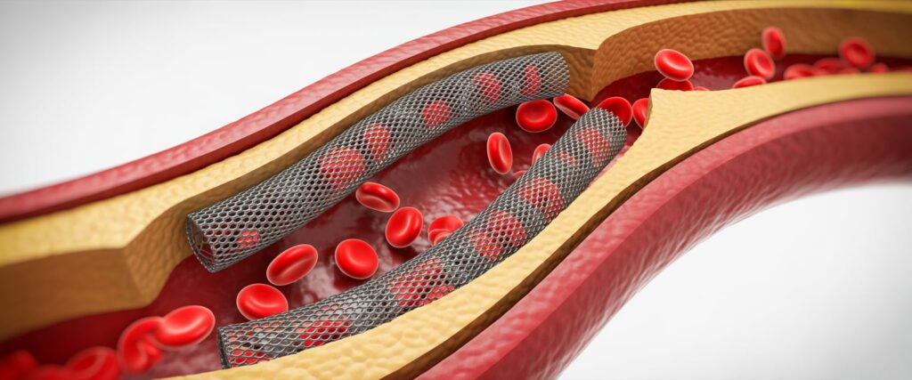 Presence of Coronary Angioplasty Implant and Graft: Codes & Clinical Relevance